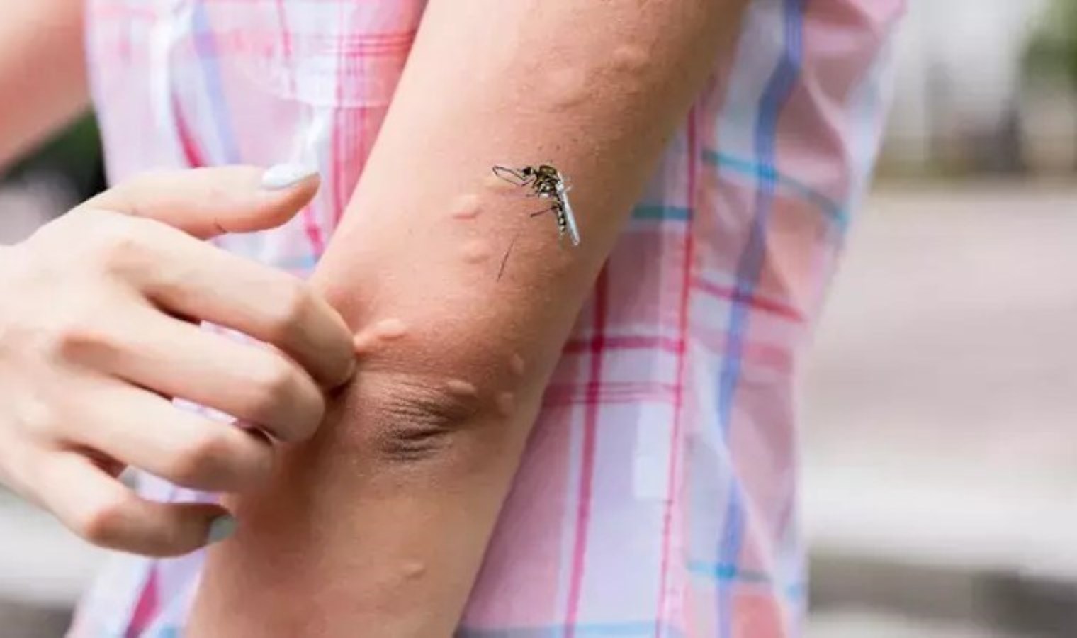 Sivrisinek ısırığına bunu yapmayın! ikincil enfeksiyon sebebi…
